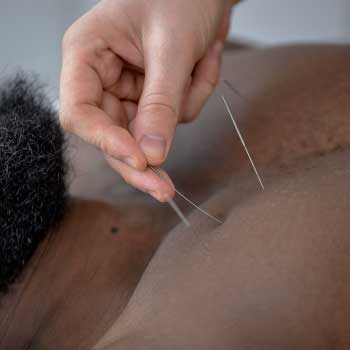 Acupuncture services Acupuncture services