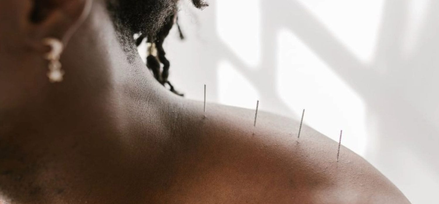 Acupuncture vs. Pain Meds